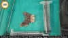Artificial Teeth Stuck in Throat Removed at Sagar BMC