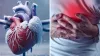 Can Heart Attack Occur Even Without High Cholesterol?