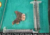 Artificial Teeth Stuck in Throat Removed at Sagar BMC