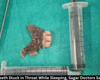 Artificial Teeth Stuck in Throat Removed at Sagar BMC
