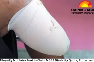 Man Allegedly Mutilates Foot to Claim MBBS Disability Quota, Probe Launched