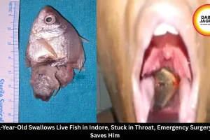 1-Year-Old Swallows Live Fish in Indore, Stuck in Throat, Emergency Surgery Saves Him